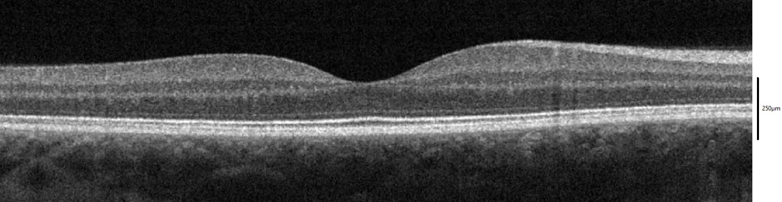 An OCT cross-section scan of a healthy macula, showing the characteristic foveal dip and distinct retinal layers